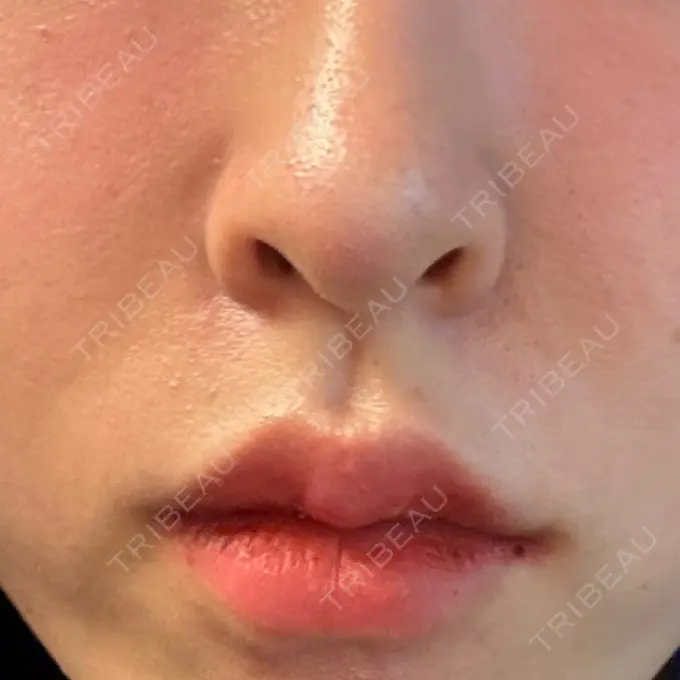 ヒアルロン酸注入（唇） / ヒアルロン酸注入（鼻翼基部） HAAB×DREAM BEAUTY CLINIC 大阪梅田院 DAY 4 メイン用