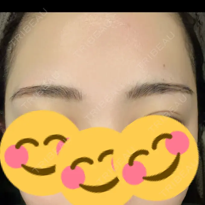 ボトックス（眉間） / アートメイク（眉） グランヴォーテ AFTER メイン用