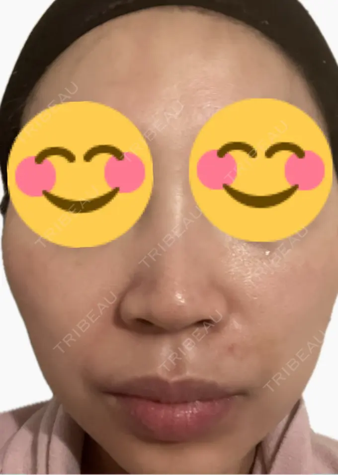 その他（肌） 美容皮膚科エルムクリニック 麻布院 AFTER メイン用