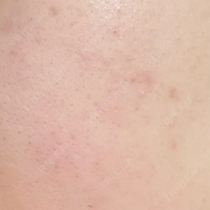 毛穴洗浄（ハイドラフェイシャルなど） さっぽろ美容クリニック AFTER メイン用