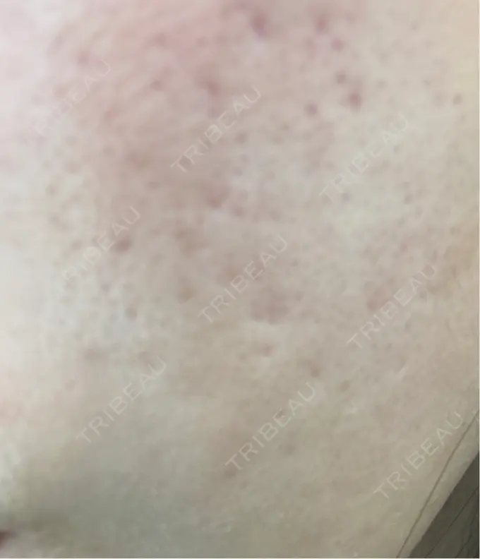 水光注射（ハリ・美肌） Chloe Cheongdam Clinic （クロエチョンダムクリニック） AFTER メイン用