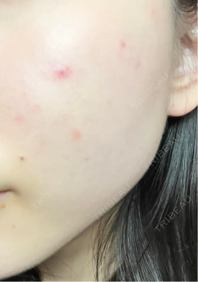 ピーリング（ニキビ・毛穴） / ルメッカ ルラ美容クリニック 大宮院 / ルラスキンクリニック 大宮院 AFTER メイン用