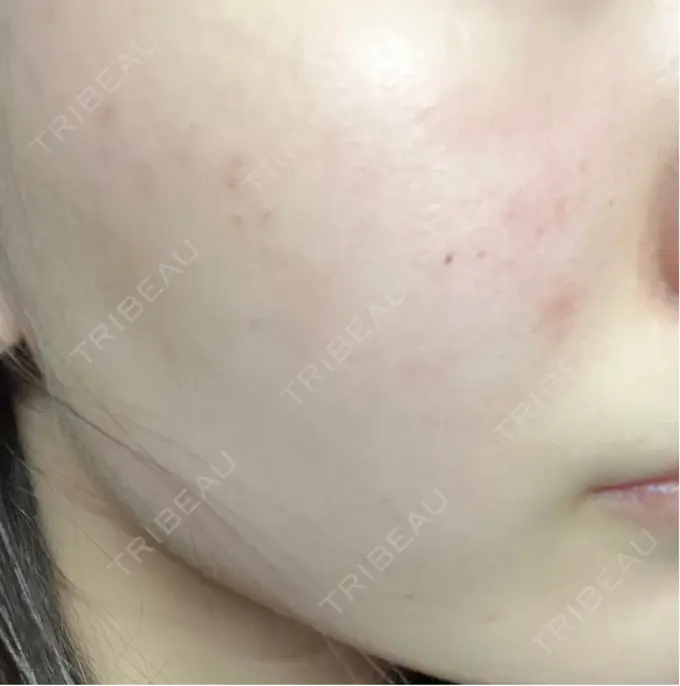 ピーリング（ニキビ・毛穴） / ルメッカ ルラ美容クリニック 大宮院 / ルラスキンクリニック 大宮院 DAY 1 メイン用