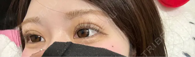 二重埋没 / 上まぶたの脂肪取り アリエル美容クリニック 水戸院 DAY 7 メイン用