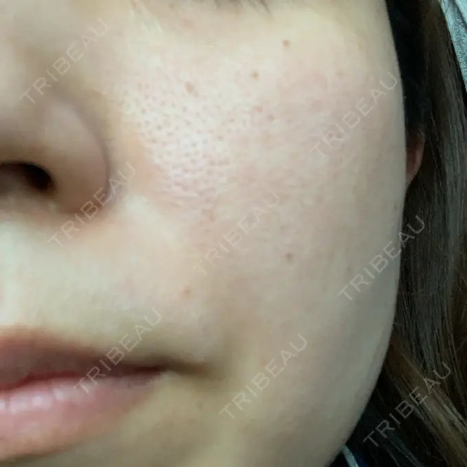 ルメッカ ルラ美容クリニック 大宮院 / ルラスキンクリニック 大宮院 AFTER メイン用