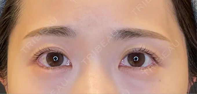 目尻切開 / タレ目形成・グラマラスライン（埋没） LOUIS CLINIC 二子玉川院【ルイクリニック】 DAY 14 メイン用