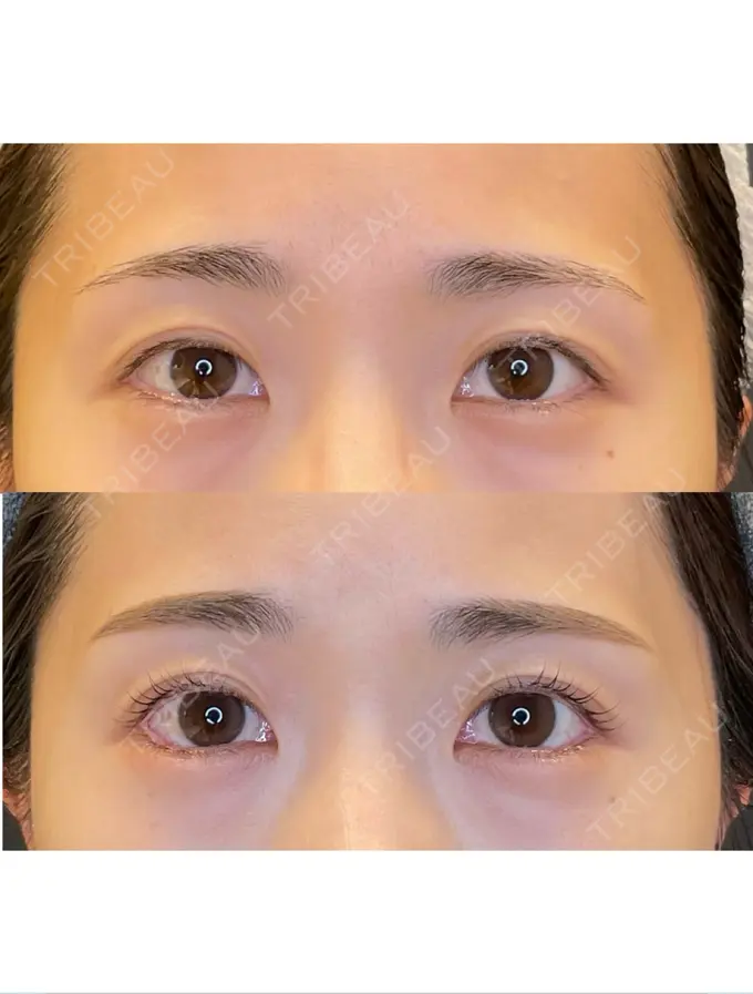 目尻切開 / タレ目形成・グラマラスライン（埋没） LOUIS CLINIC 二子玉川院【ルイクリニック】 DAY 14 メイン用