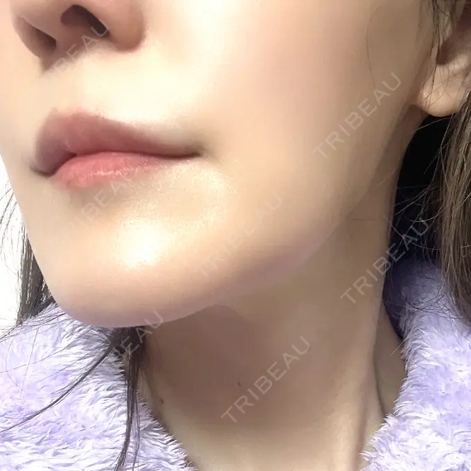 デンシティ First Clinic AFTER メイン用