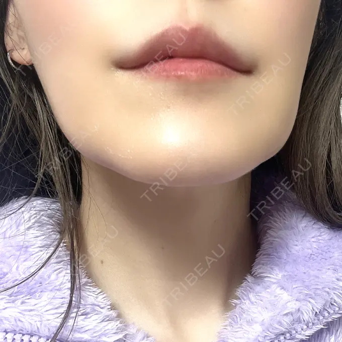 デンシティ First Clinic DAY 5 メイン用