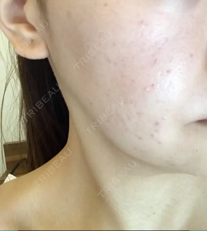 フォトRF 東京美容外科 梅田院 DAY 0 メイン用