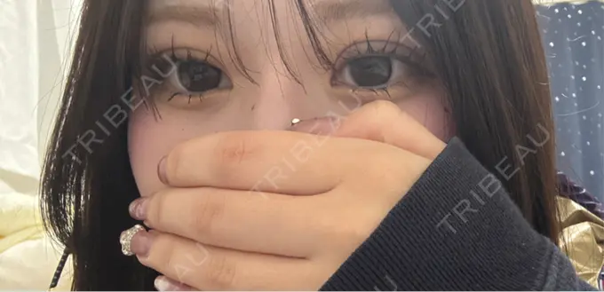 二重埋没 / 上まぶたの脂肪取り アリエル美容クリニック 水戸院 DAY 8 メイン用