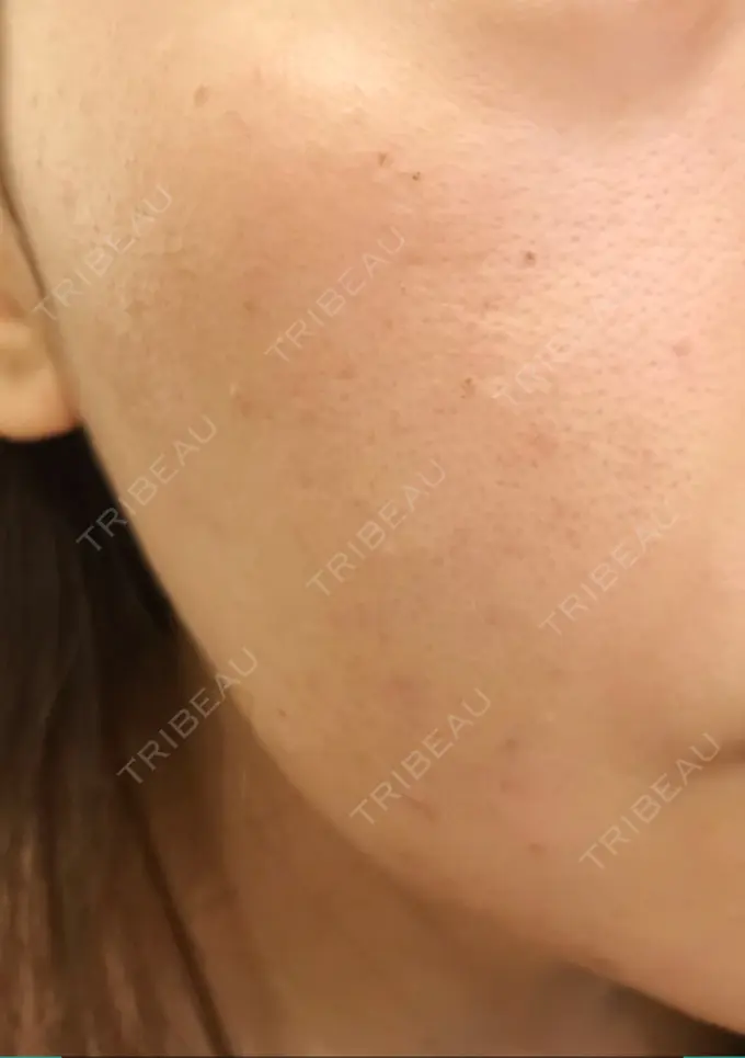 フォトRF 東京美容外科 梅田院 DAY 1 メイン用