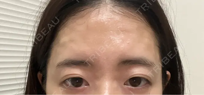 肌育注射（ジュベルックなど） ゆきスキンクリニック 東池袋 DAY 0 メイン用