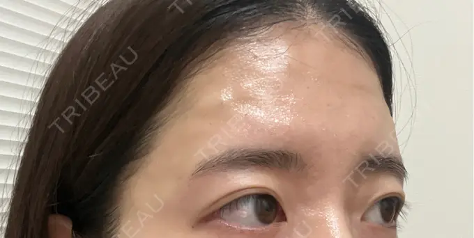 肌育注射（ジュベルックなど） ゆきスキンクリニック 東池袋 DAY 0 メイン用