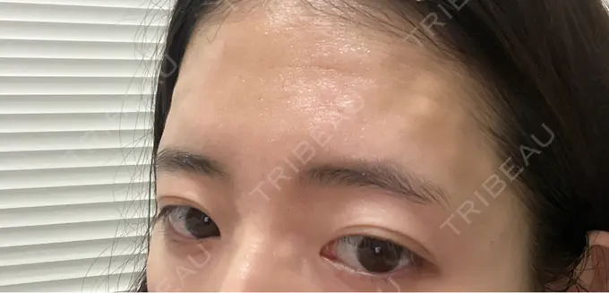 肌育注射（ジュベルックなど） ゆきスキンクリニック 東池袋 DAY 0 メイン用