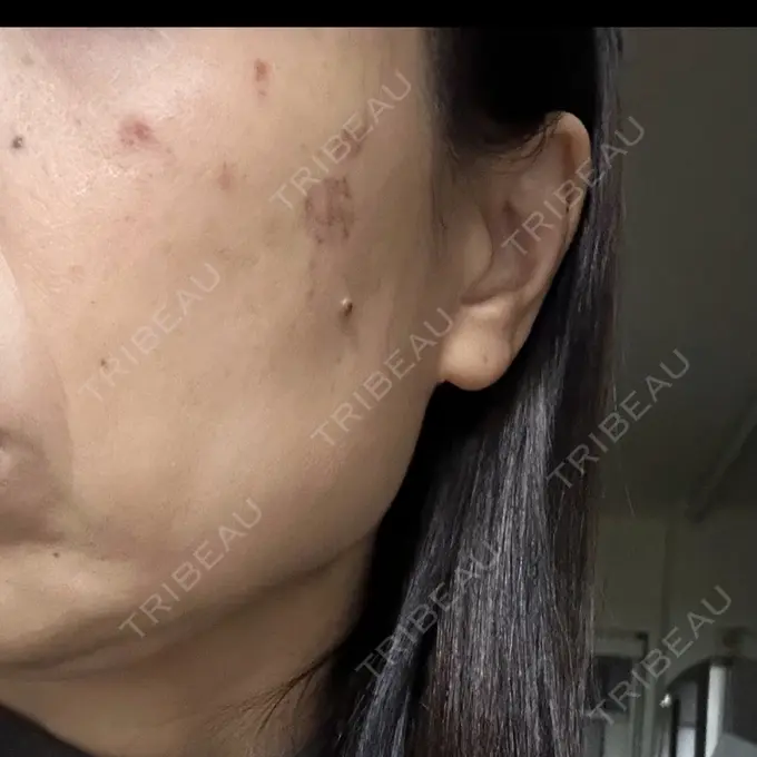 シミ取りレーザー さっぽろ美容クリニック DAY 1 メイン用