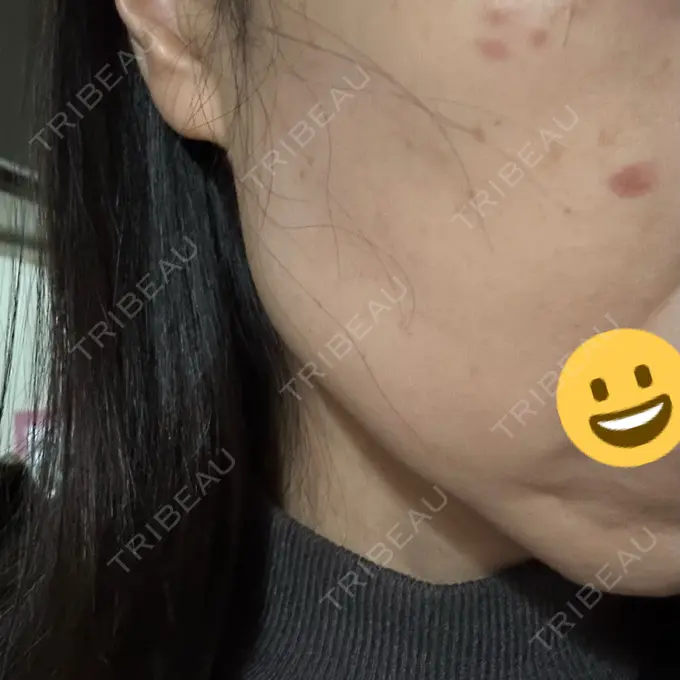 シミ取りレーザー さっぽろ美容クリニック DAY 1 メイン用