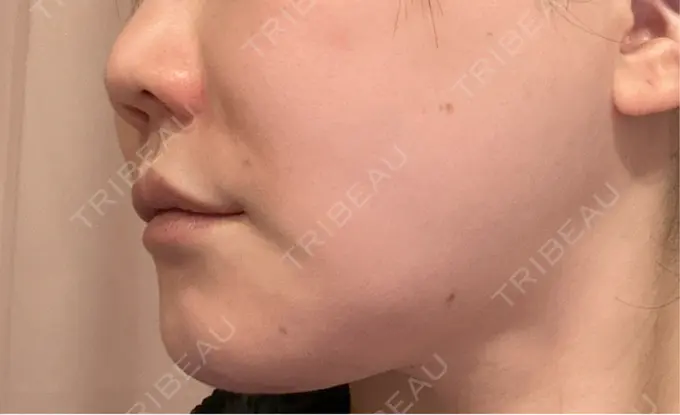 ヒアルロン酸注入（鼻翼基部） ルラ美容クリニック 仙台院 / ルラスキンクリニック 仙台院 DAY 0 メイン用