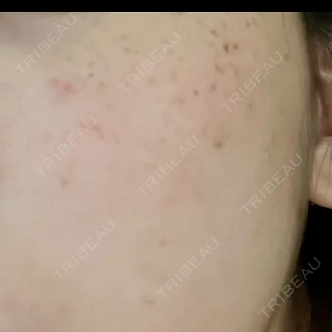 イオン導入 / ピーリング（ハリ・ツヤ） / ルメッカ ルラ美容クリニック 千葉院 / ルラスキンクリニック 千葉院 DAY 0 メイン用