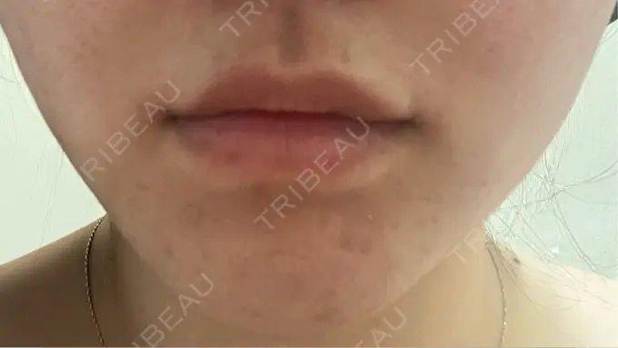 ヒアルロン酸注入（唇） / ボトックス（口角） / インモード 東京美容皮膚科アロエクリニック池袋 DAY 1 メイン用