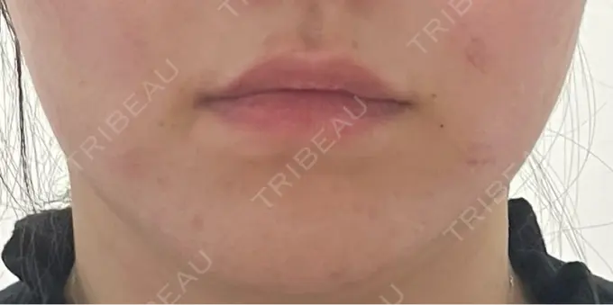 ヒアルロン酸注入（唇） / ボトックス（口角） / インモード 東京美容皮膚科アロエクリニック池袋 DAY 0 メイン用