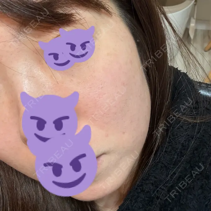 ルビーレーザー AZ BEAUTY CLINIC AFTER メイン用