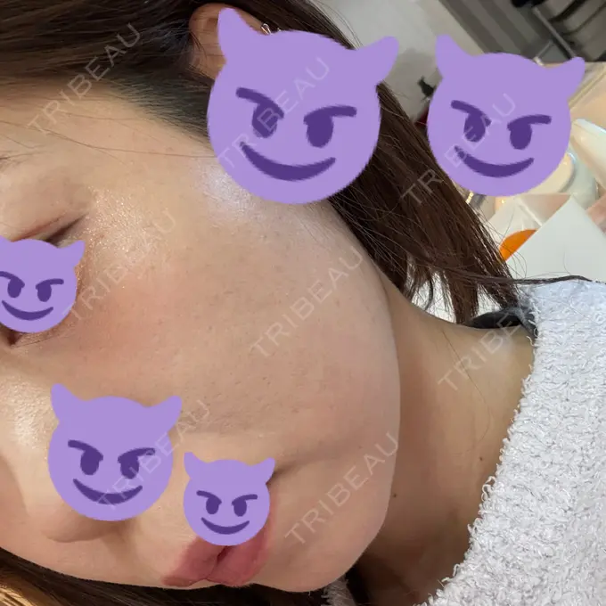 ルビーレーザー AZ BEAUTY CLINIC DAY 6 メイン用