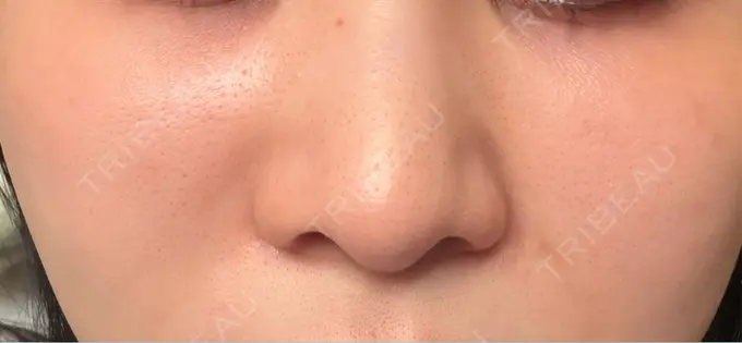 レーザーフェイシャル 矢場町ひふ形成外科クリニック AFTER メイン用