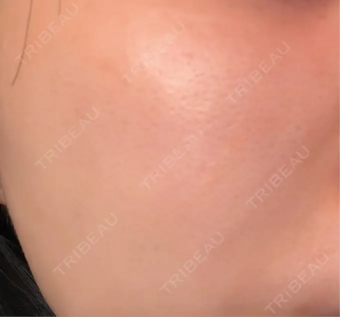 レーザーフェイシャル 矢場町ひふ形成外科クリニック DAY 15 メイン用