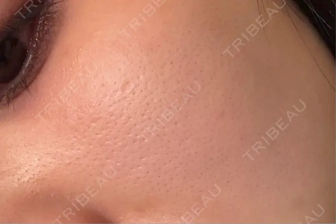 レーザーフェイシャル 矢場町ひふ形成外科クリニック DAY 15 メイン用