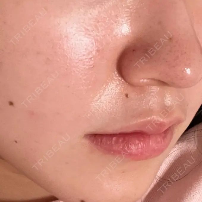 肌育注射（ジュベルックなど） ハナビューティークリニック AFTER メイン用