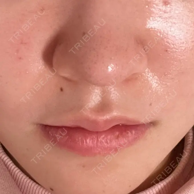 肌育注射（ジュベルックなど） ハナビューティークリニック DAY 1 メイン用