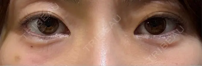 クマ治療 Days Beauty Clinic 新宿院 DAY 0 メイン用