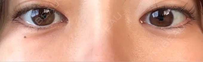 クマ治療 Days Beauty Clinic 新宿院 AFTER メイン用