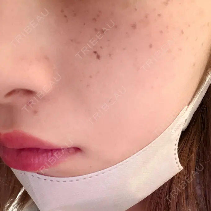 ルメッカ 博多美容外科/美容皮膚科 ビラビューティークリニック DAY 2 メイン用