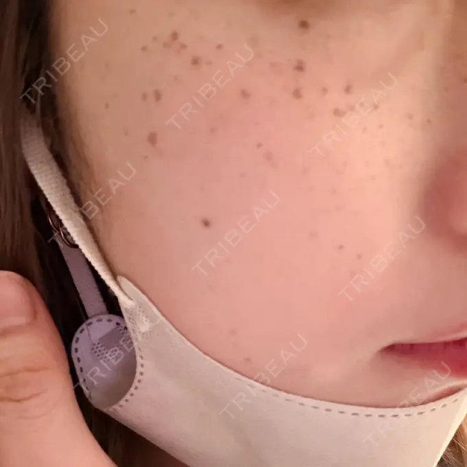 ルメッカ 博多美容外科/美容皮膚科 ビラビューティークリニック DAY 2 メイン用