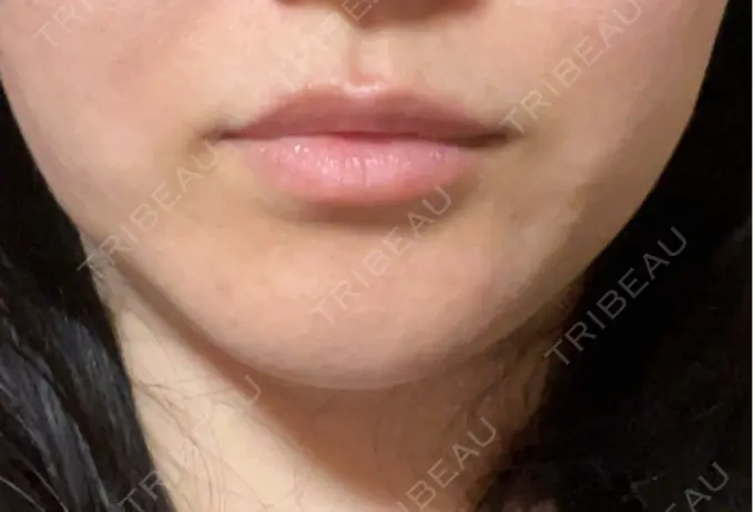 ヒアルロン酸注入（唇） / ボトックス（口角） / インモード 東京美容皮膚科アロエクリニック池袋 DAY 3 メイン用