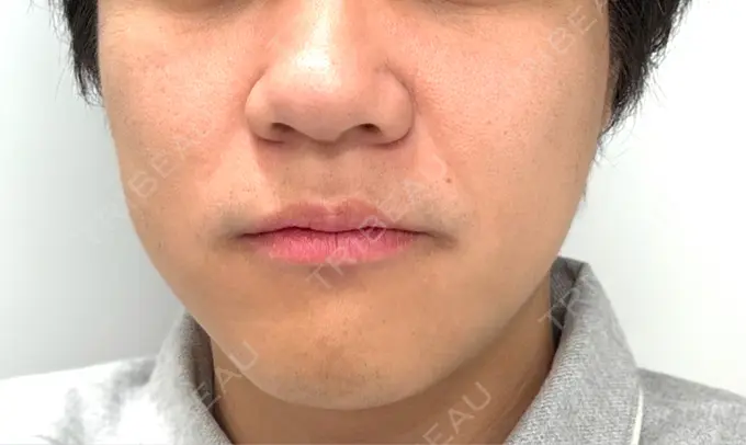 糸リフト / 肌ヒアルロン酸注入（たるみ・シワ改善） アイネクリニック　川崎院 DAY 5 メイン用