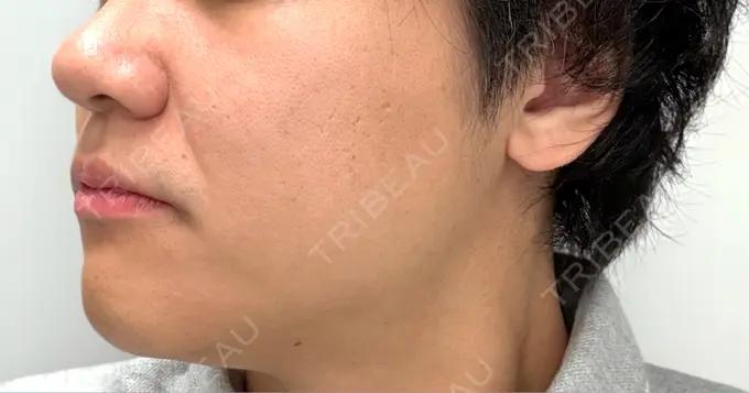 糸リフト / 肌ヒアルロン酸注入（たるみ・シワ改善） アイネクリニック　川崎院 DAY 5 メイン用