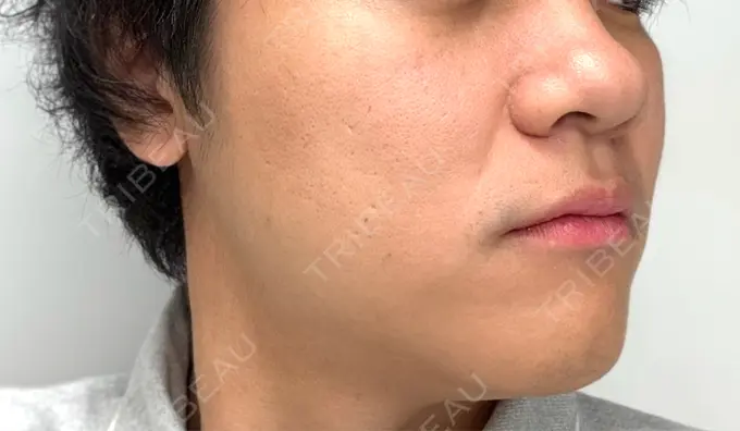 糸リフト / 肌ヒアルロン酸注入（たるみ・シワ改善） アイネクリニック　川崎院 DAY 5 メイン用