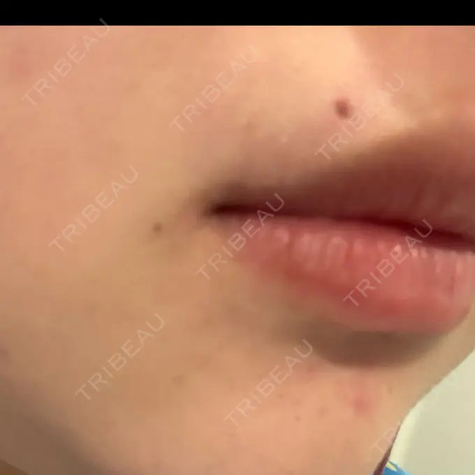 ほくろ・いぼ切除（肌） R Beauty CLINIC 名古屋院 DAY 3 メイン用