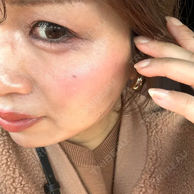 ヒアルロン酸注入（涙袋） アネシス美容クリニック DAY 0 メイン用