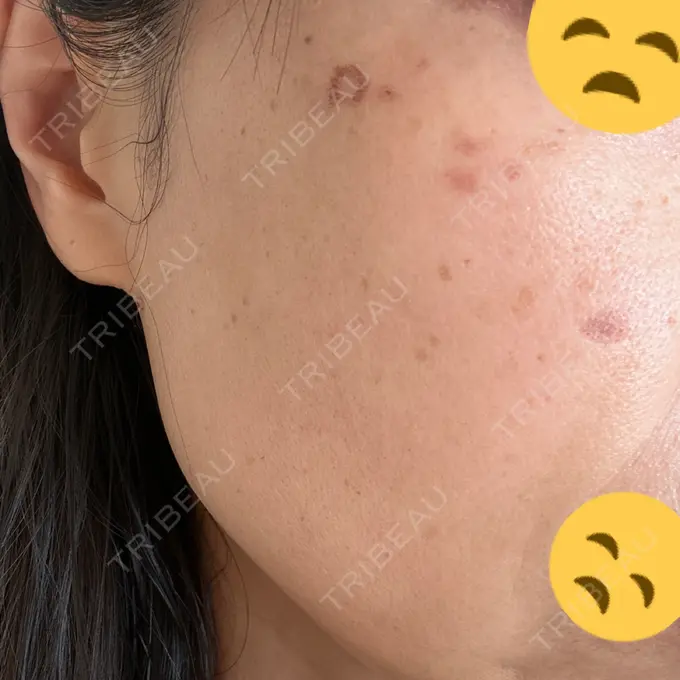 シミ取りレーザー さっぽろ美容クリニック DAY 3 メイン用