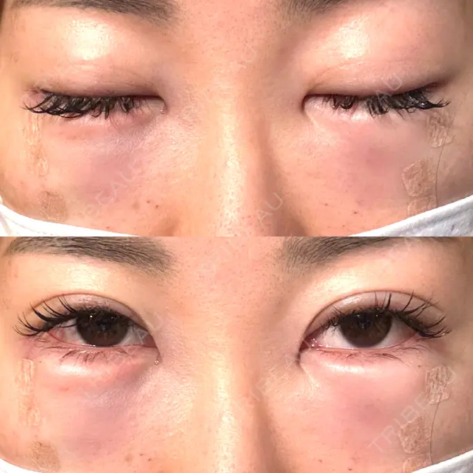 クマ治療 / 脂肪注入（目の下） / その他（口元） 湘南美容クリニック 千葉センシティ院 DAY 0 メイン用