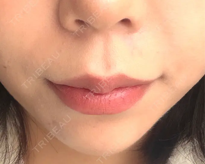 ボトックス（あご） / ヒアルロン酸注入（あご） / ヒアルロン酸注入（唇） / ボトックス（口角） / ヒアルロン酸注入（鼻翼基部） ルラ美容クリニック 大阪本院 AFTER メイン用