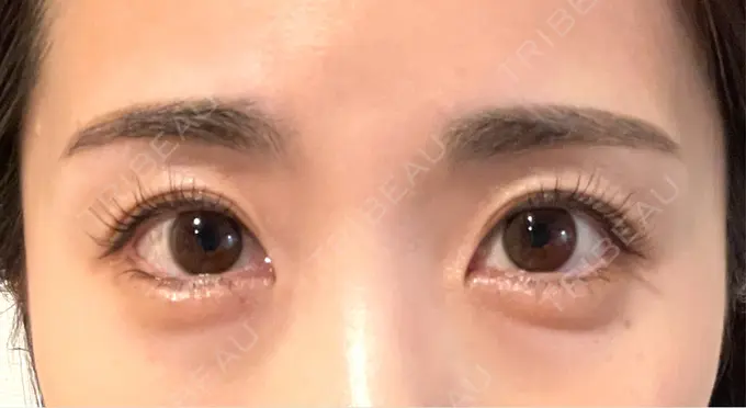 目尻切開 / タレ目形成・グラマラスライン（埋没） LOUIS CLINIC 二子玉川院【ルイクリニック】 AFTER メイン用