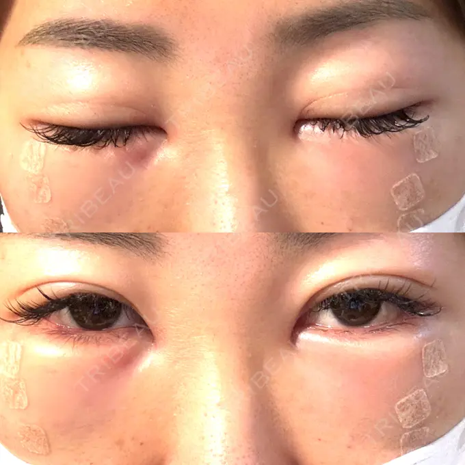 クマ治療 / 脂肪注入（目の下） / その他（口元） 湘南美容クリニック 千葉センシティ院 DAY 1 メイン用