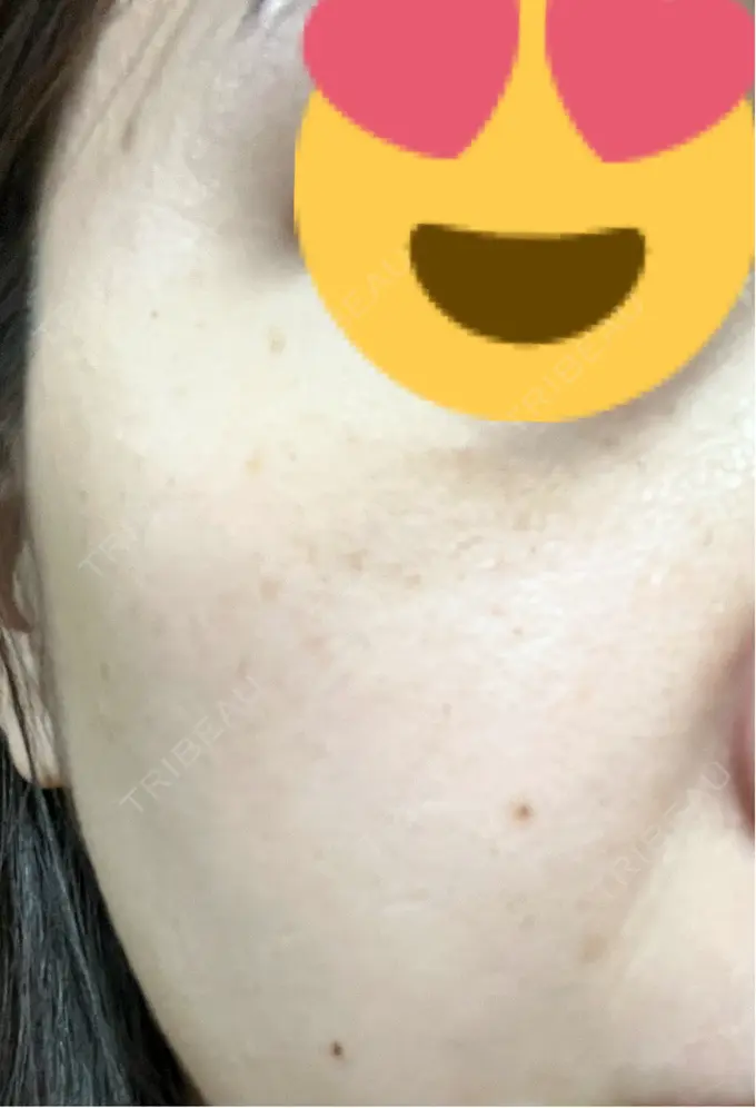 イオン導入 / ピーリング（ハリ・ツヤ） / ルメッカ ルラ美容クリニック 千葉院 / ルラスキンクリニック 千葉院 DAY 3 メイン用