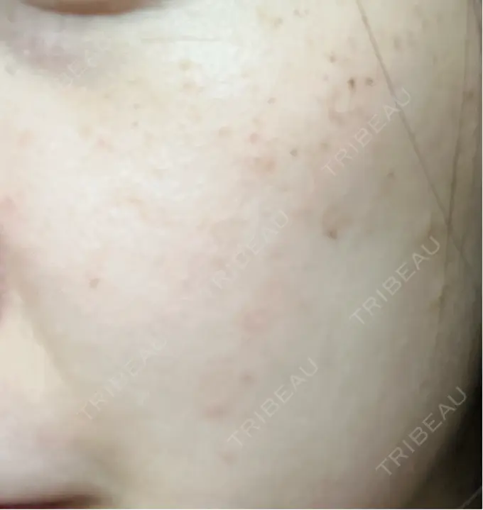 イオン導入 / ピーリング（ハリ・ツヤ） / ルメッカ ルラ美容クリニック 千葉院 / ルラスキンクリニック 千葉院 DAY 3 メイン用