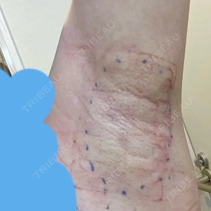 ワキ汗治療（レーザー） ルラ美容クリニック 渋谷本院 DAY 0 メイン用